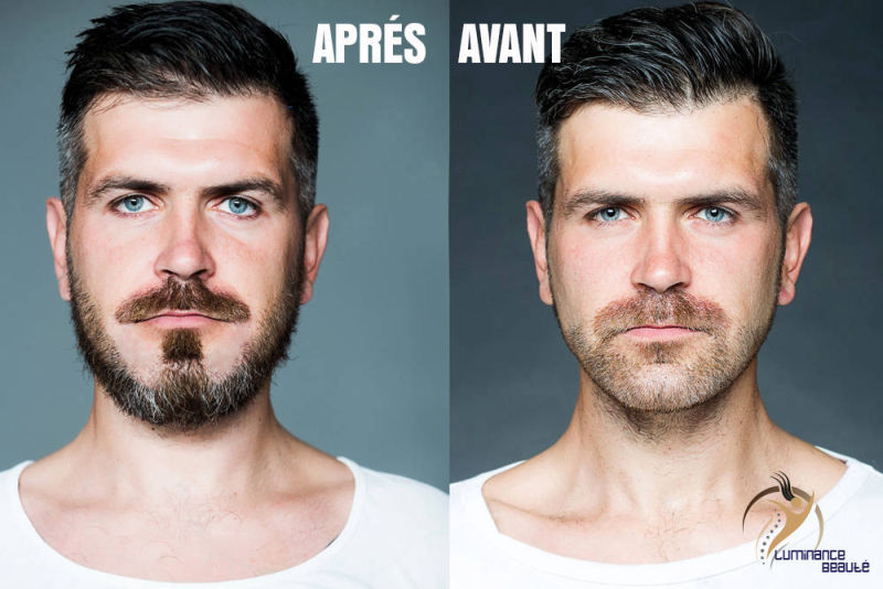 Photo greffe de barbe