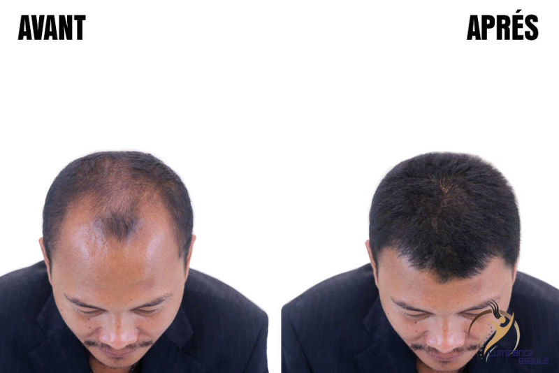 Photo greffe cheveux avant apres homme