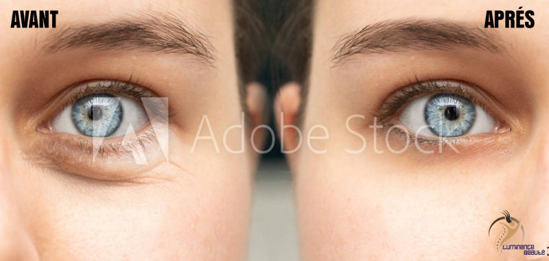 Photo opération des yeux